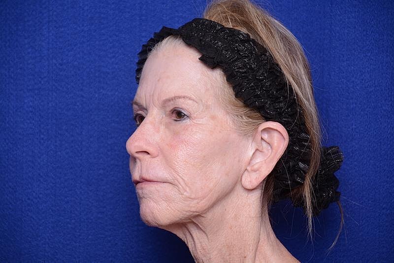 Upper Blepharoplasty Before & After