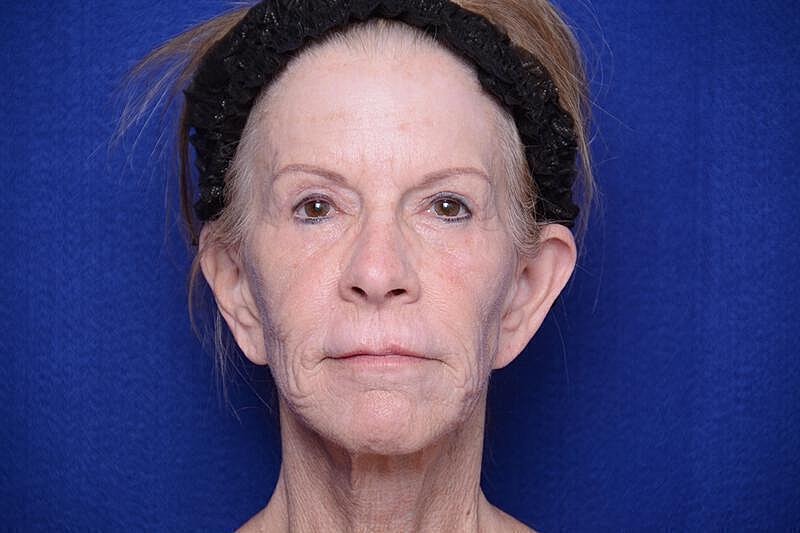 Upper Blepharoplasty Before & After