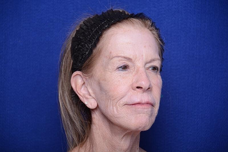 Upper Blepharoplasty Before & After
