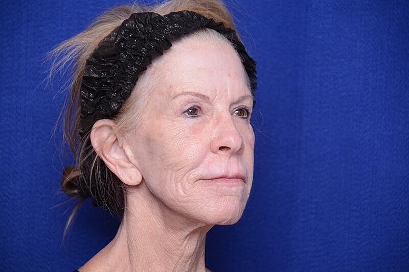 Upper Blepharoplasty Before & After