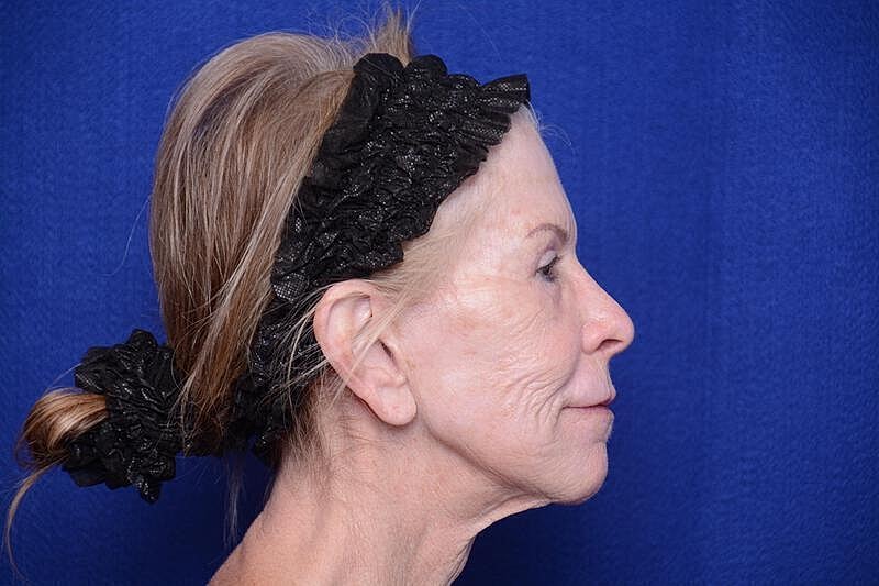 Upper Blepharoplasty Before & After