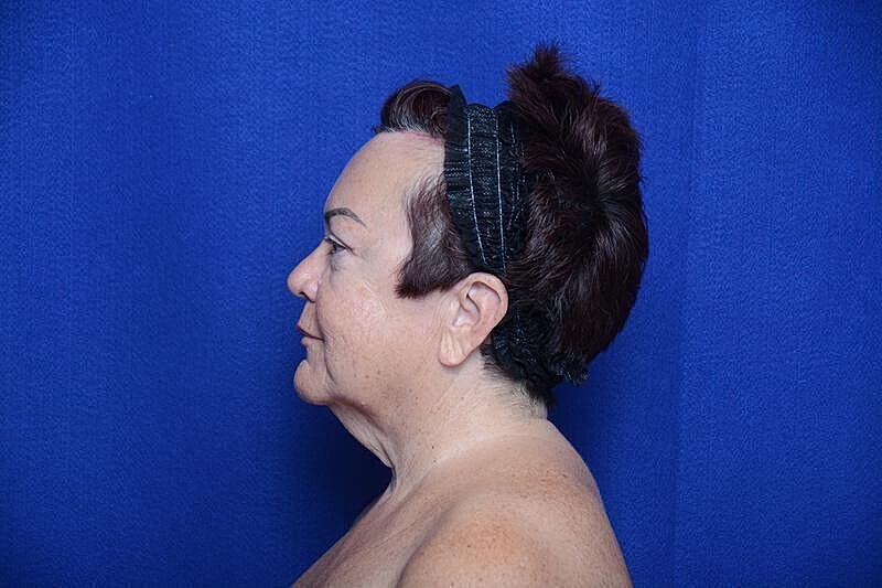 Upper Blepharoplasty Before & After