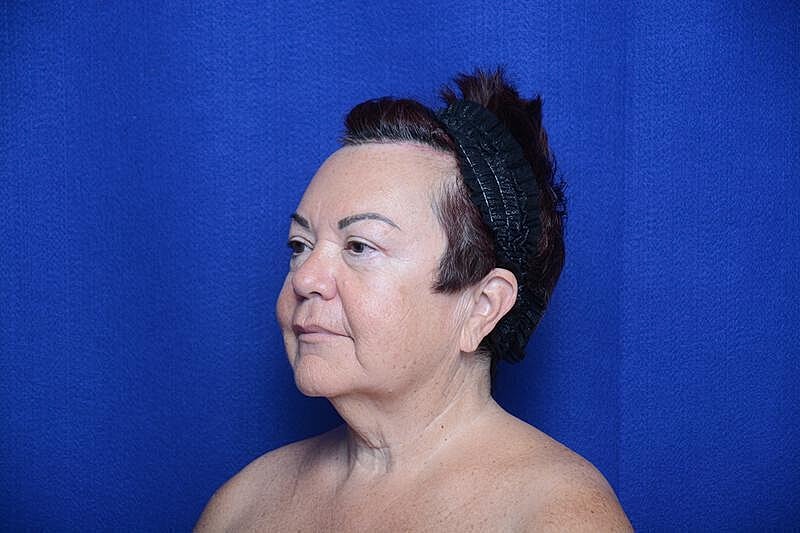 Upper Blepharoplasty Before & After