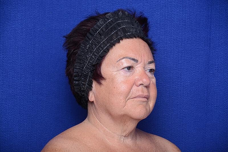 Upper Blepharoplasty Before & After