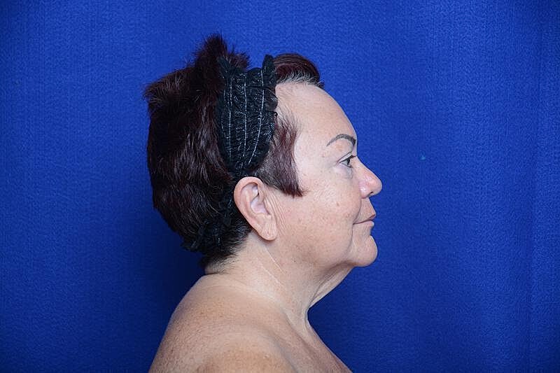 Upper Blepharoplasty Before & After