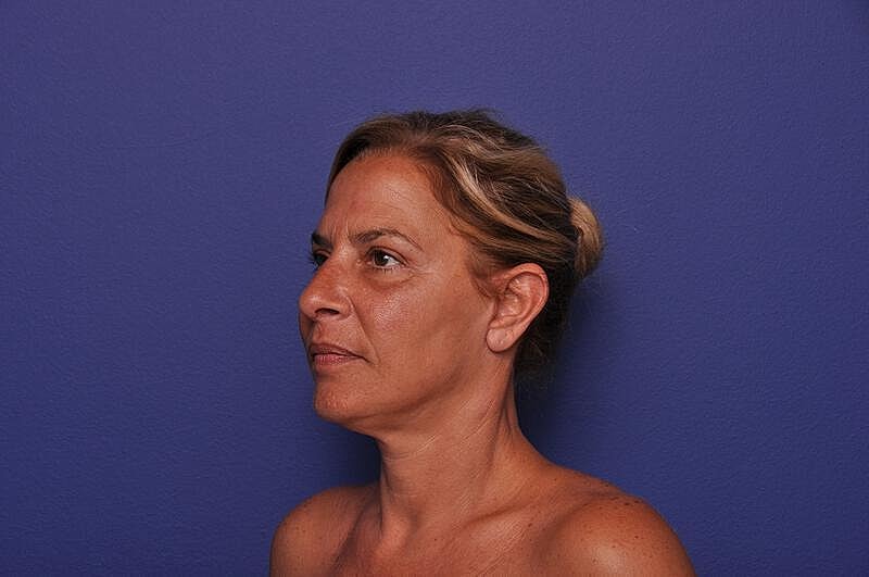 Upper Blepharoplasty Before & After