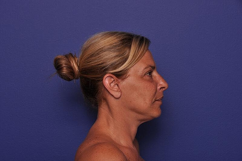Upper Blepharoplasty Before & After