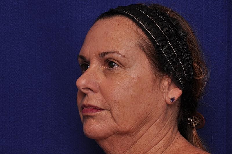 Upper Blepharoplasty Before & After