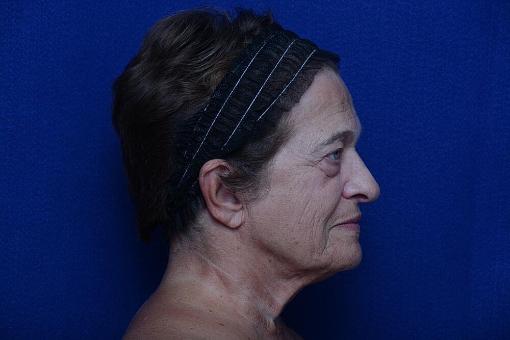 Upper Blepharoplasty Before & After
