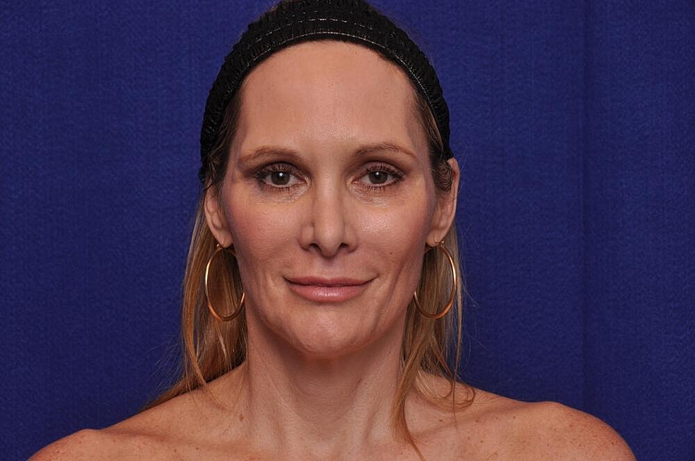Upper Blepharoplasty Before & After