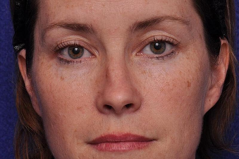 Injectable Cheek Lift Before & After