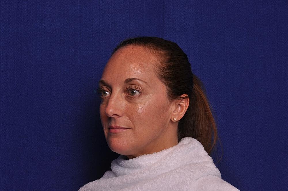 Injectable Cheek Lift Before & After
