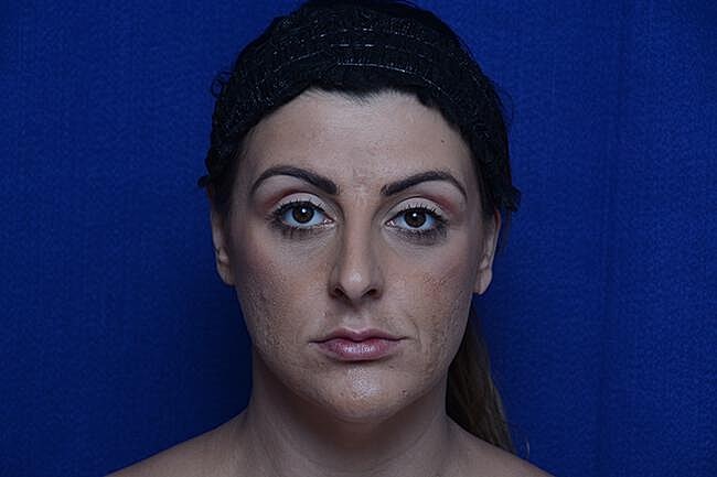 Injectable Cheek Lift Before & After