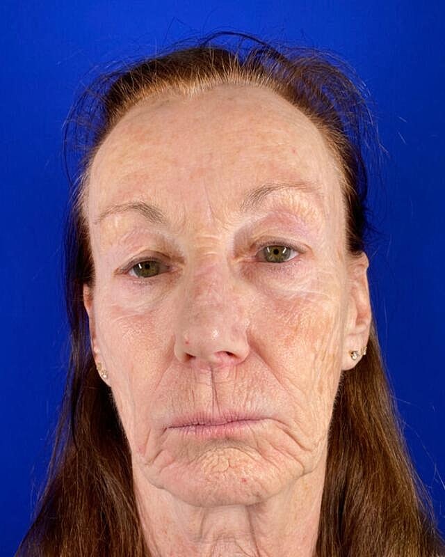 Injectable Cheek Lift Before & After