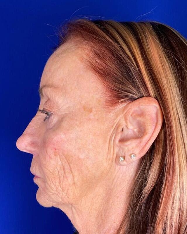 Injectable Cheek Lift Before & After