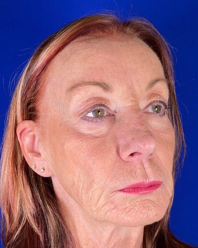 Injectable Cheek Lift Before & After