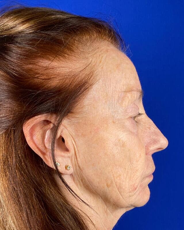 Injectable Cheek Lift Before & After