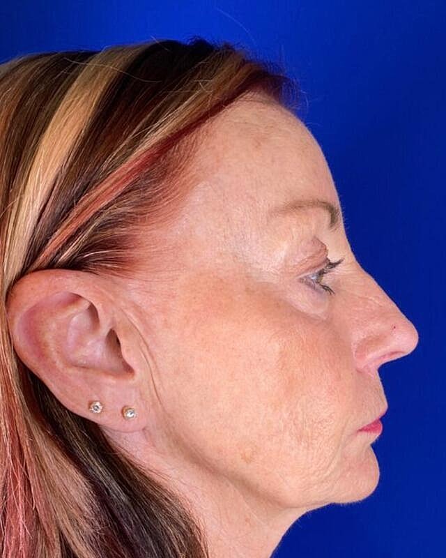 Injectable Cheek Lift Before & After