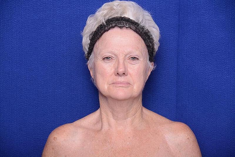 Lower Blepharoplasty Before & After