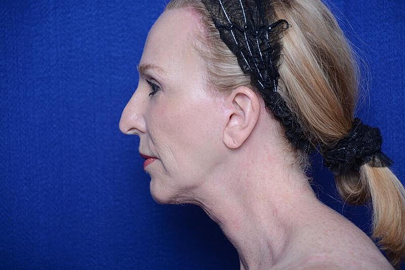 Lower Blepharoplasty Before & After