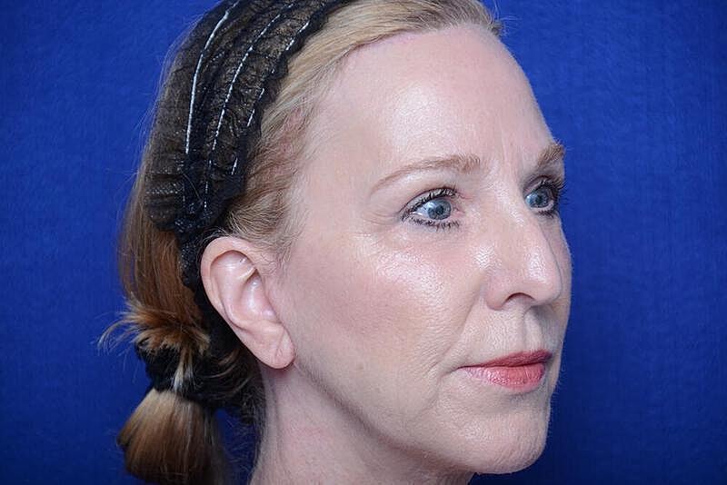 Lower Blepharoplasty Before & After