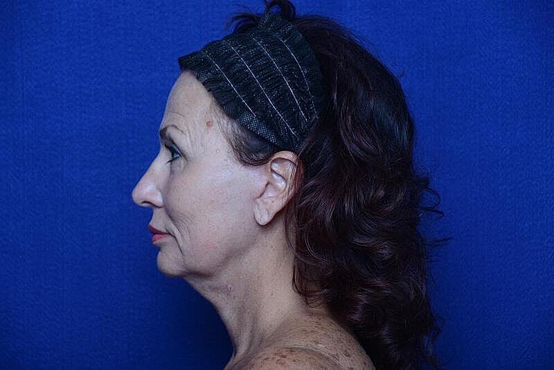Lower Blepharoplasty Before & After