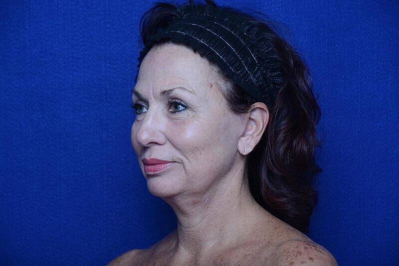 Lower Blepharoplasty Before & After