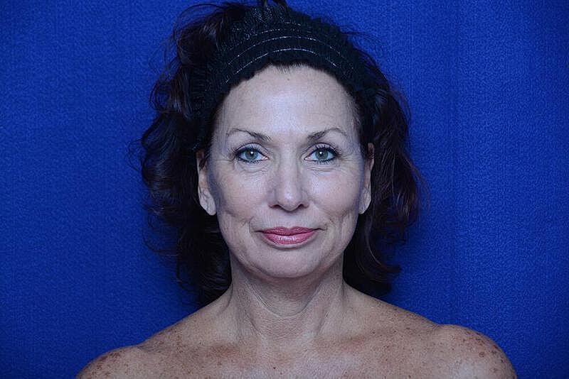 Lower Blepharoplasty Before & After
