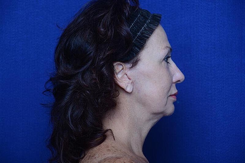 Lower Blepharoplasty Before & After