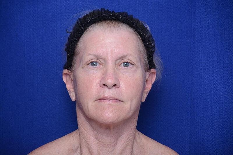Lower Blepharoplasty Before & After