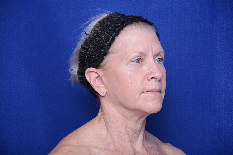 Lower Blepharoplasty Before & After