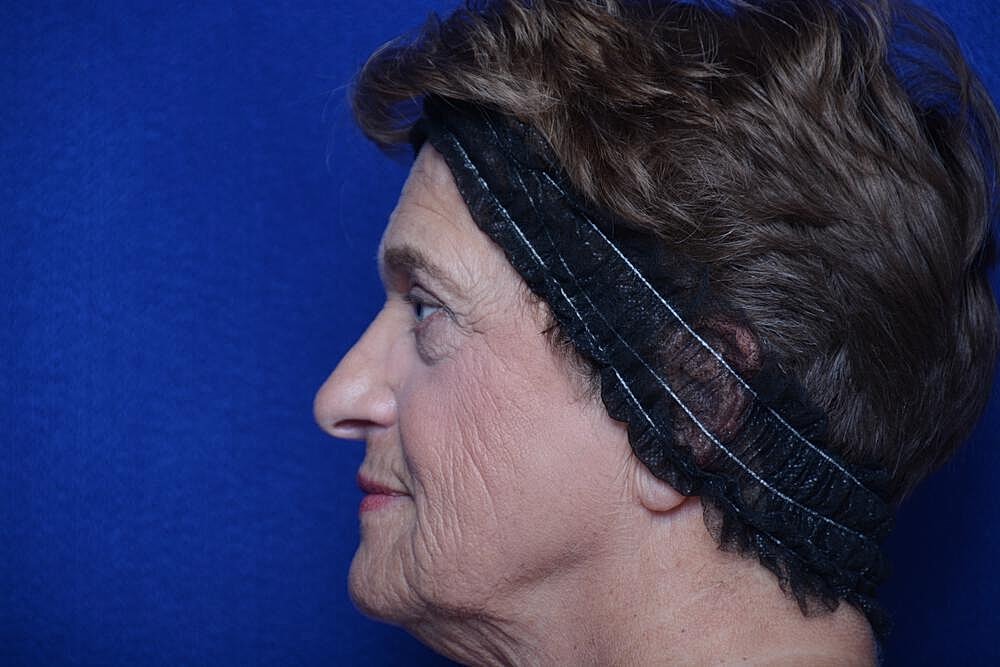 Lower Blepharoplasty Before & After