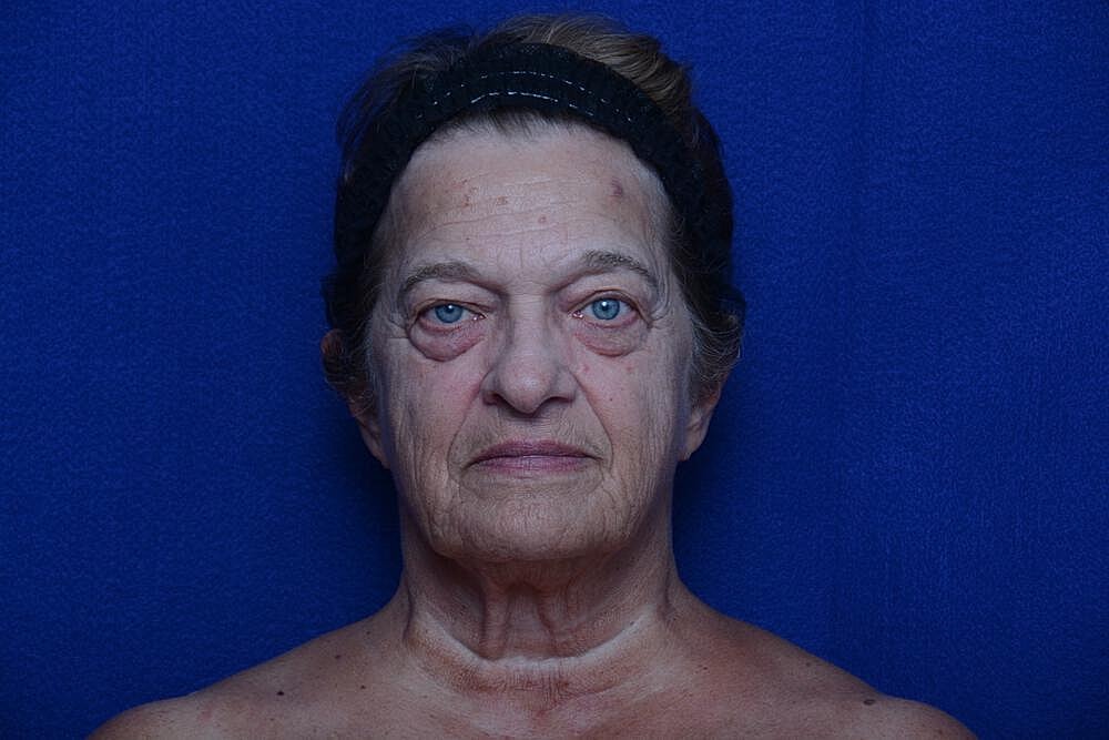 Lower Blepharoplasty Before & After