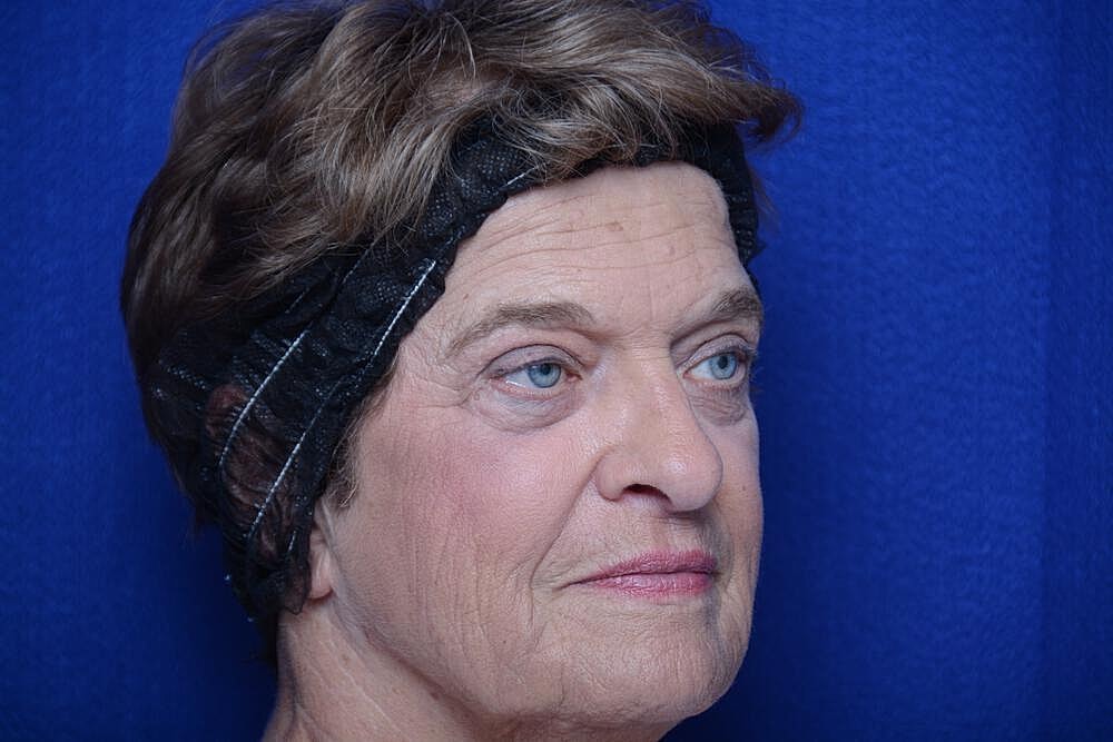 Lower Blepharoplasty Before & After