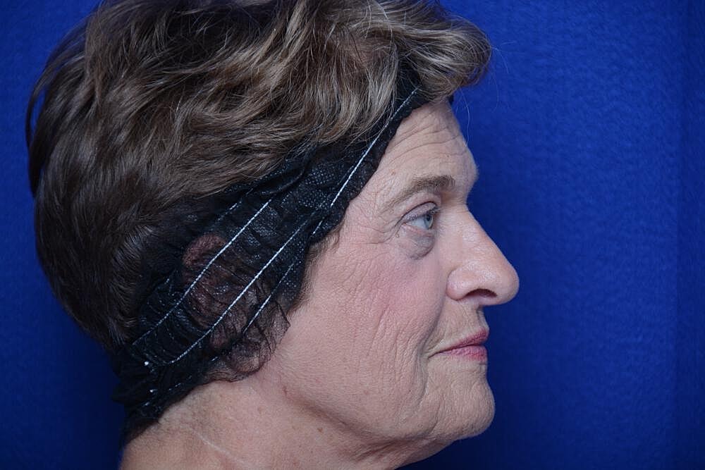 Lower Blepharoplasty Before & After
