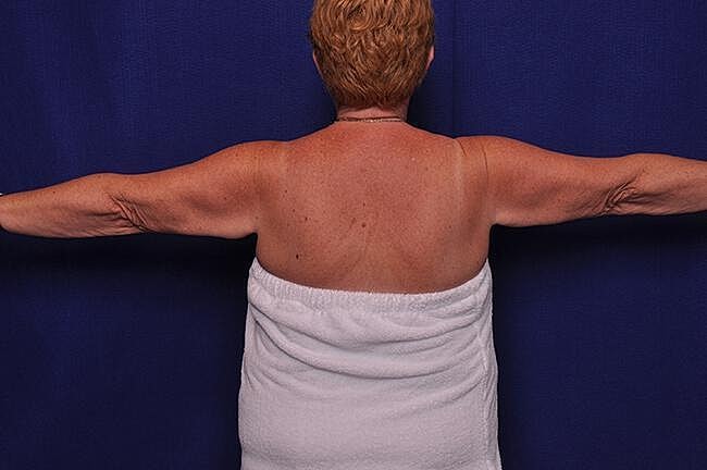 Arm Lift Before & After