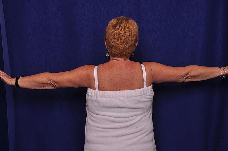 Arm Lift Before & After