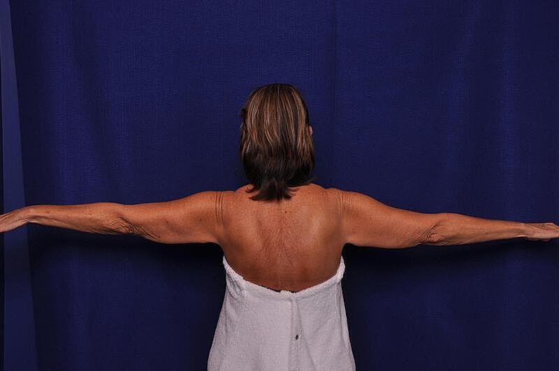 Arm Lift Before & After