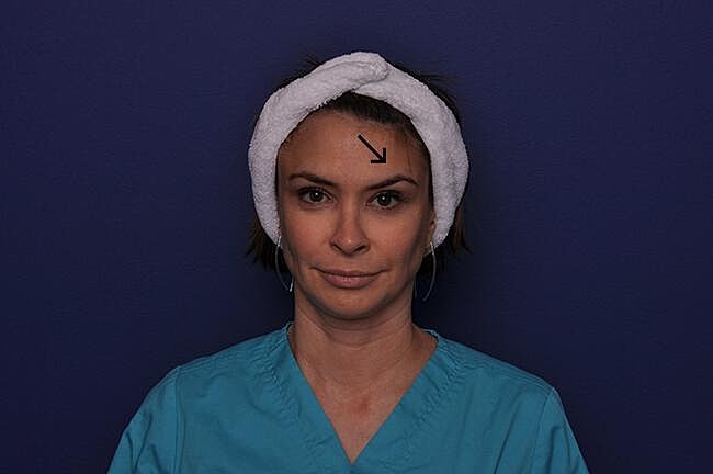 Botox Before & After