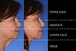 Custom Face Lift
