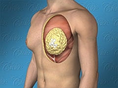 Fatty Gynecomastia 