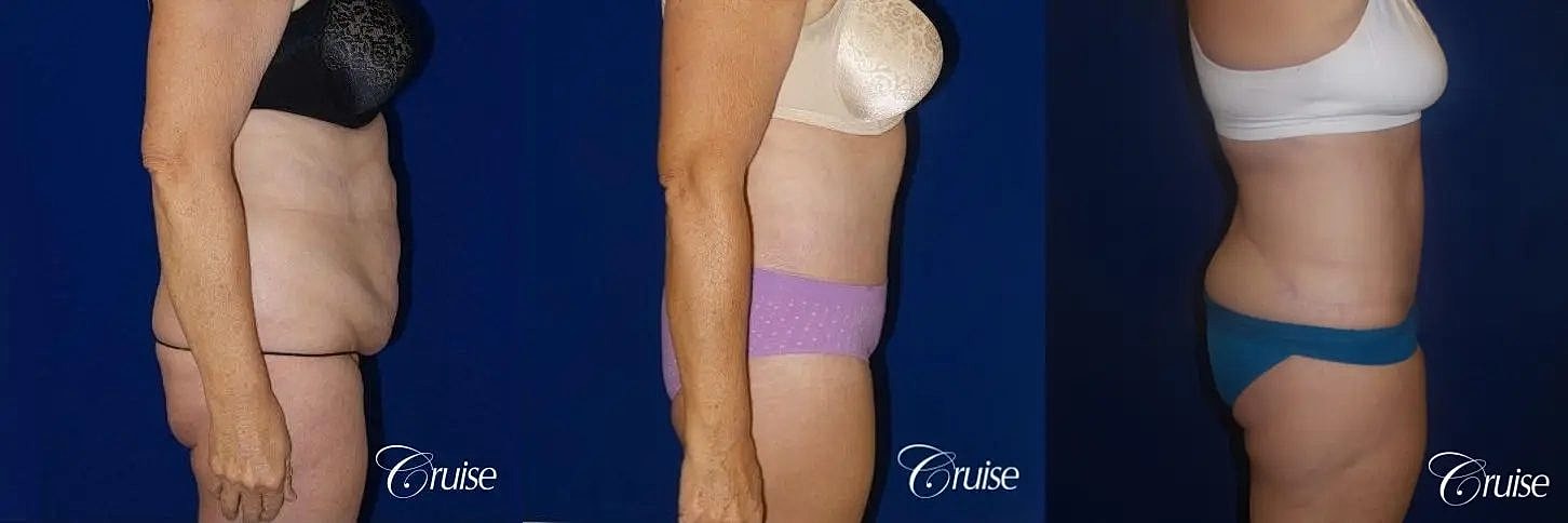 Tummy Tuck Before & After