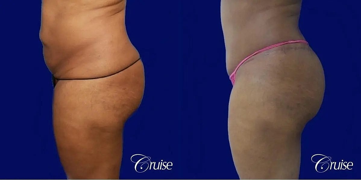 Tummy Tuck Before & After