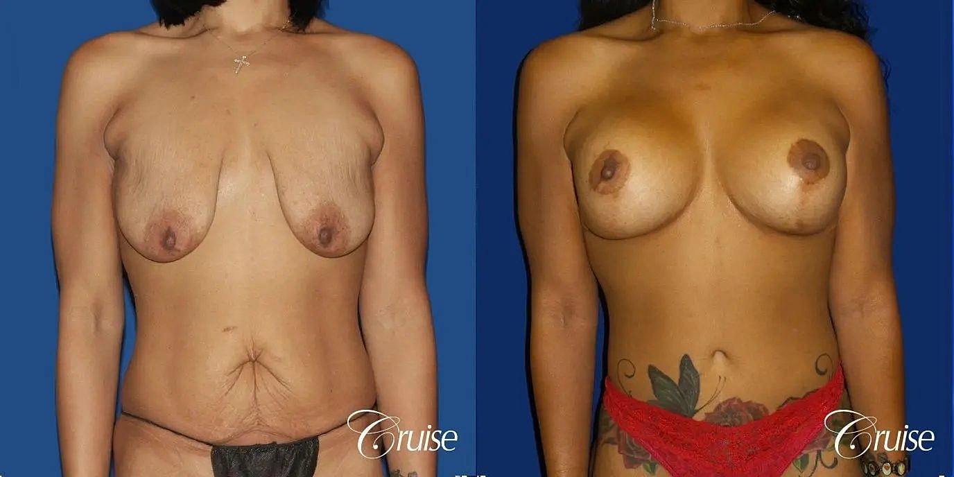 Tummy Tuck Before & After