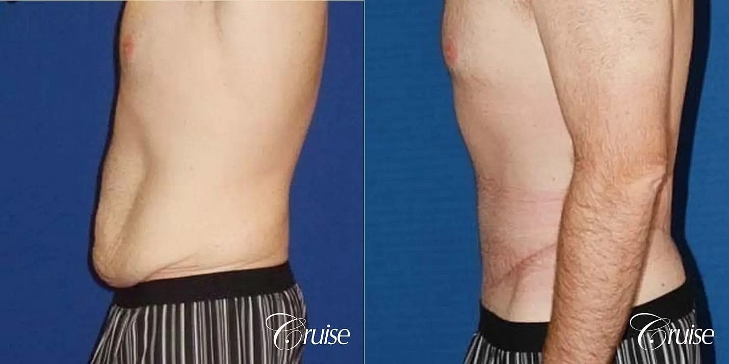 Tummy Tuck Before & After