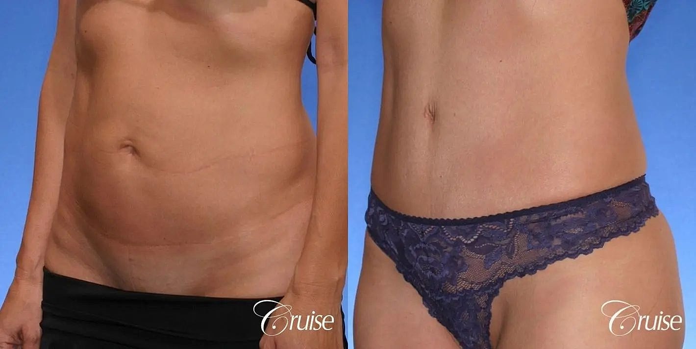 Tummy Tuck Before & After