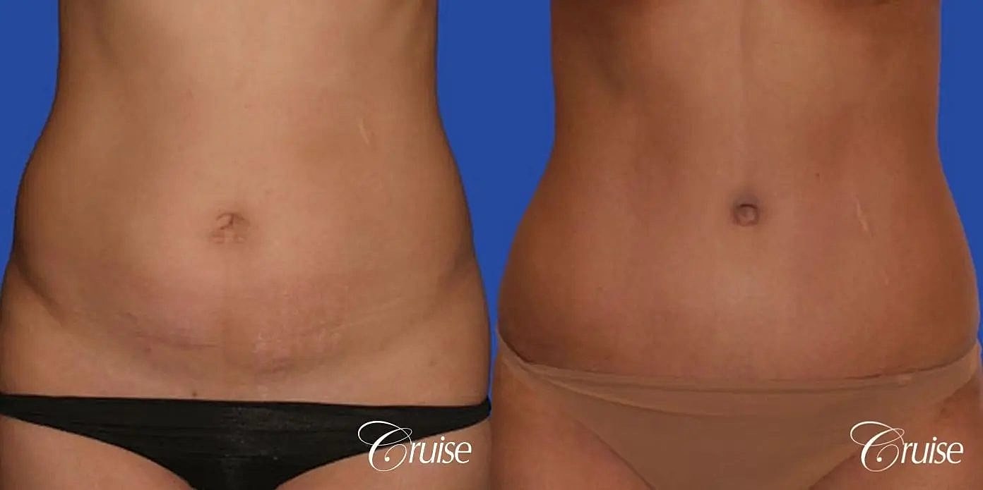 Tummy Tuck Before & After