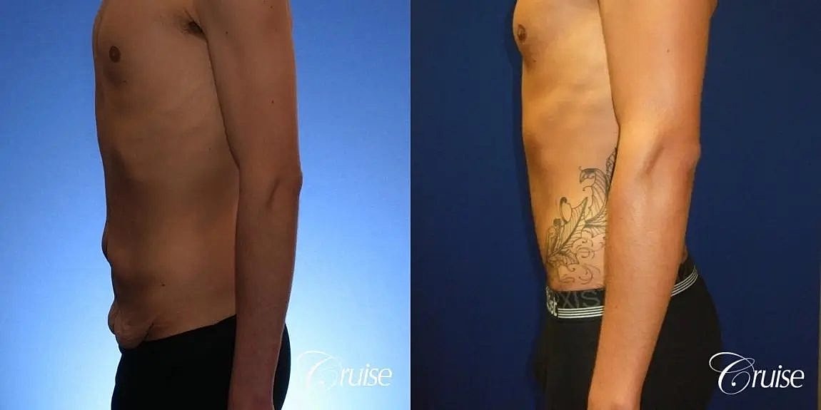 Tummy Tuck Before & After