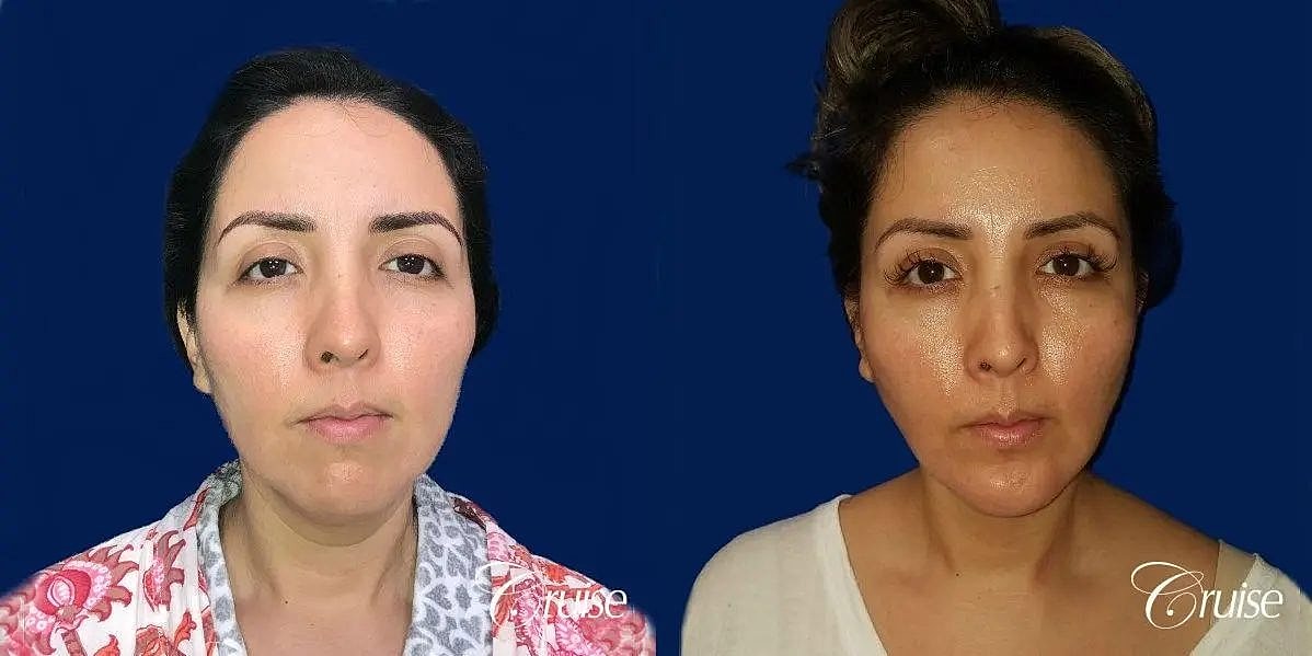 Liposuction Before & After