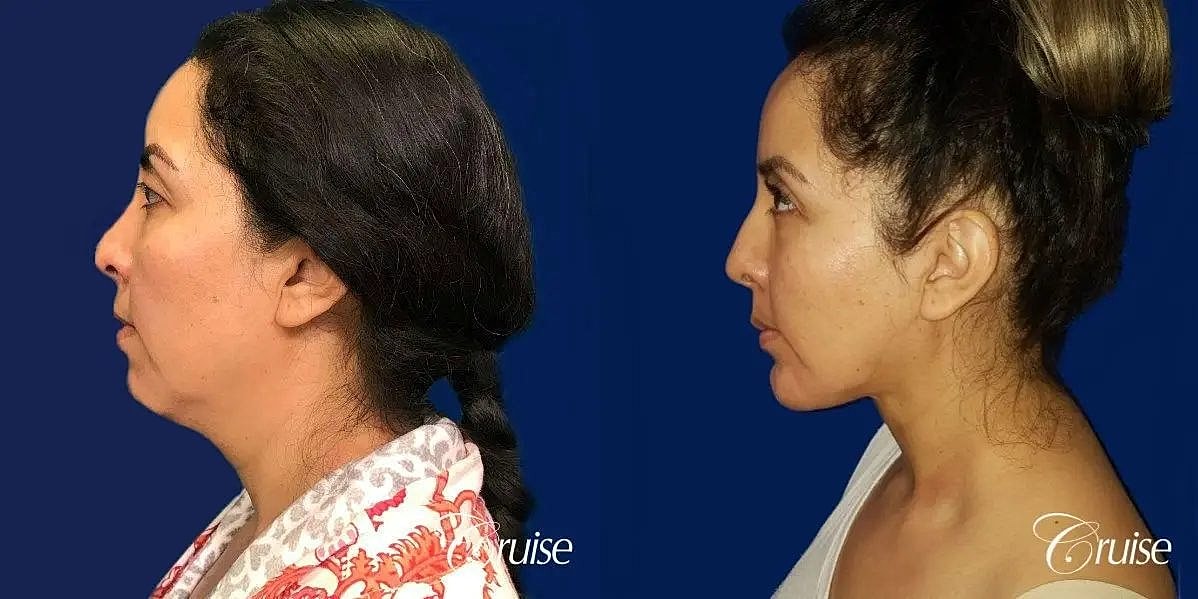 Liposuction Before & After